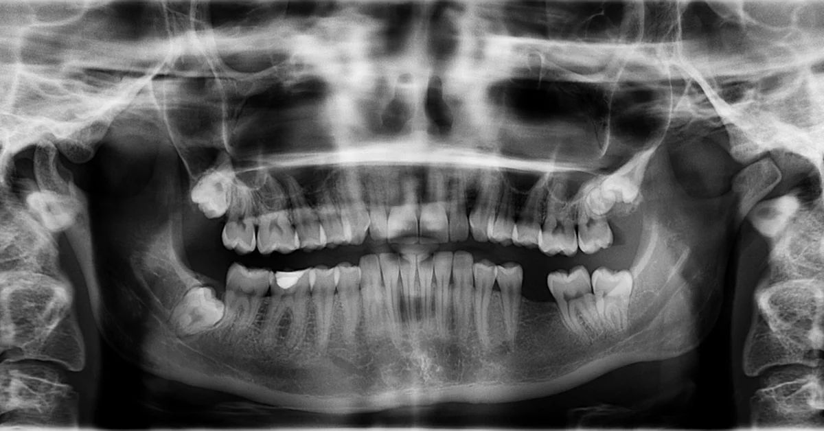 Panoramic dental X-ray showing crowded and misaligned teeth, illustrating malocclusion due to overgrown teeth.